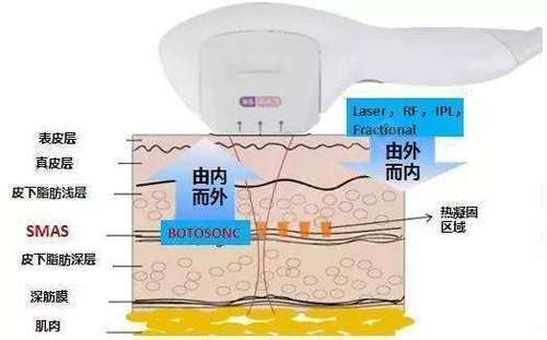 苹果美版跟韩版:超声刀的原理与作用，超声刀的副作用是什么